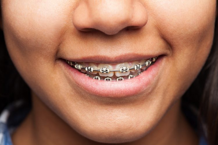 Invisalign vs. Traditional Braces: Choosing What’s Best for You at Dynamic Dental Scarborough