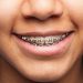 Invisalign vs. Traditional Braces: Choosing What’s Best for You at Dynamic Dental Scarborough