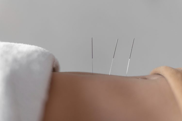 Combining Dry Needling and Physical Therapy for Optimal Pain Relief in Huntsville