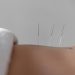 Combining Dry Needling and Physical Therapy for Optimal Pain Relief in Huntsville