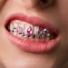 The Pros of Getting Tooth Gems: A Sparkling Trend in Dental Fashion