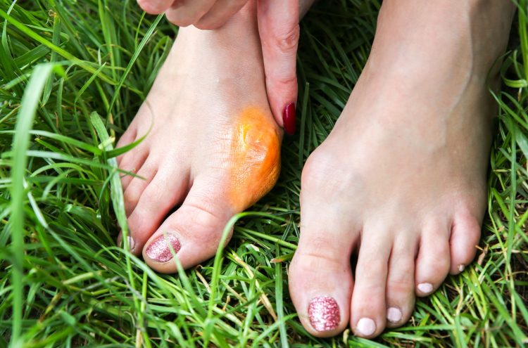 Can Footwear Choices Influence the Development of Bunions?