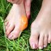 Can Footwear Choices Influence the Development of Bunions?