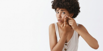 Acne and Scars: Why Some Marks Fade and Others Stay (and What Skin Actually Needs to Heal)